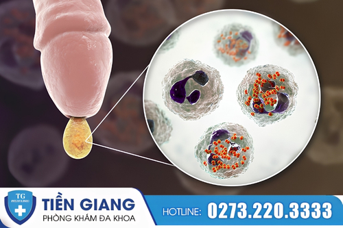 Viêm bao quy đầu gây nên tình trạng đau rát dương vật.