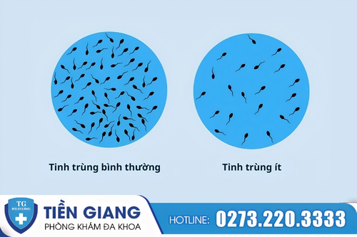 HÌnh ảnh tinh trùng ít ở nam giới.